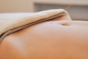 close up of fertility acupuncture treatment applied to the uterus area below the navel