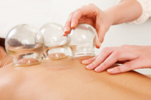 Detail of an acupuncture therapist removing a glass globe in a fire cupping procedure Seattle WA